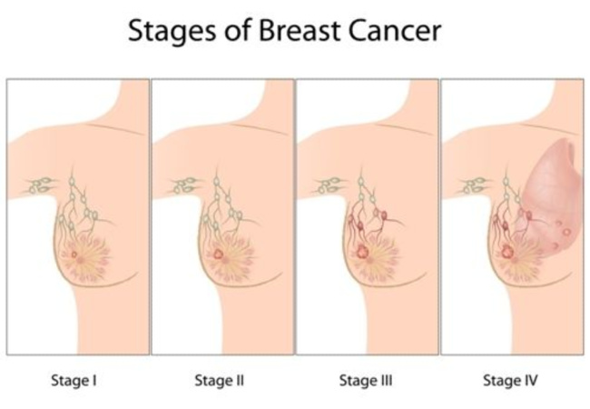 Breast Cancer Stages