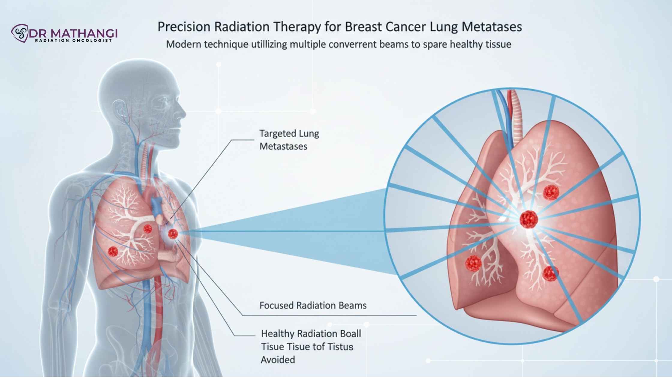 Radiiation for breast cancer