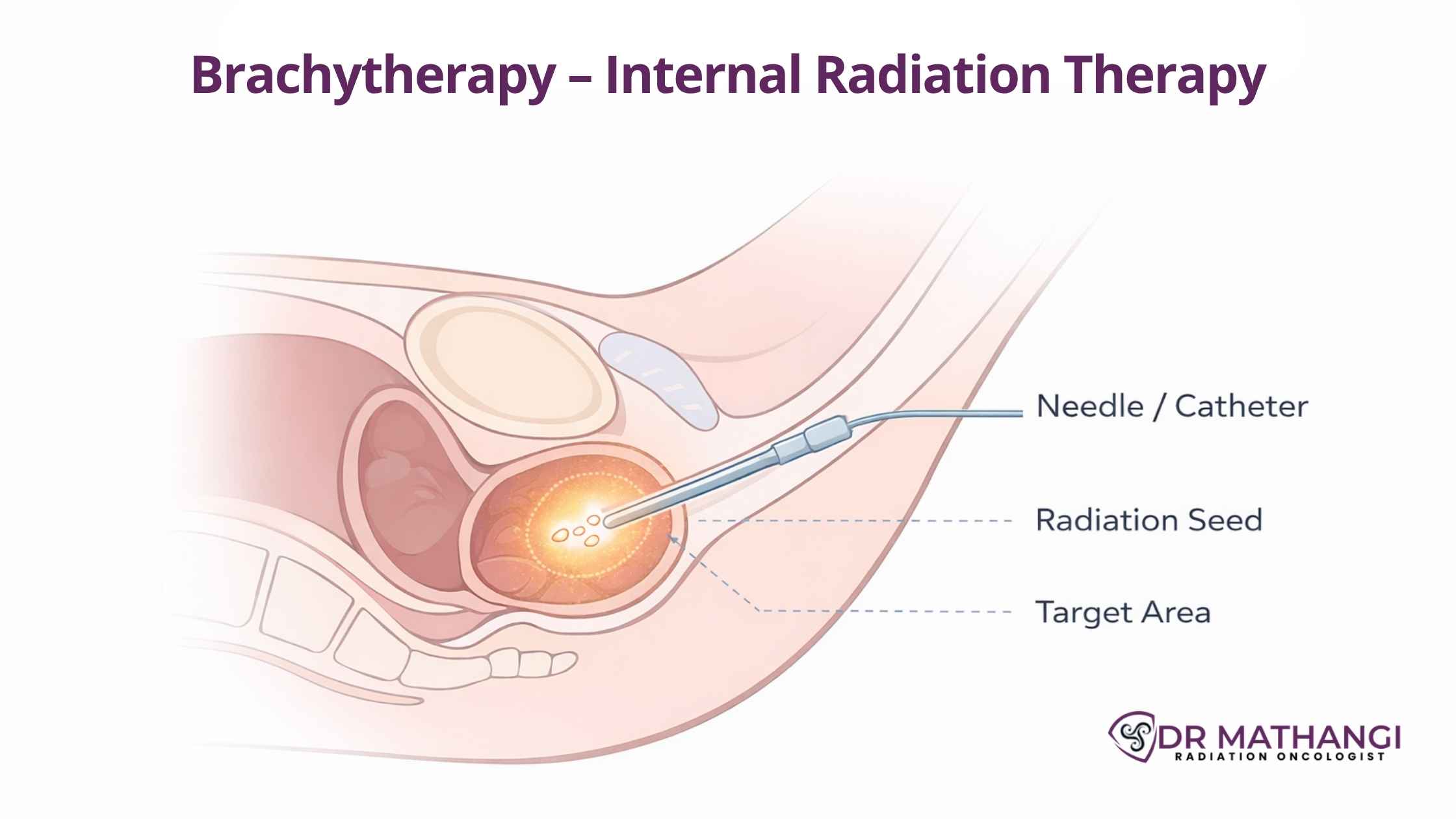 Internal radiation