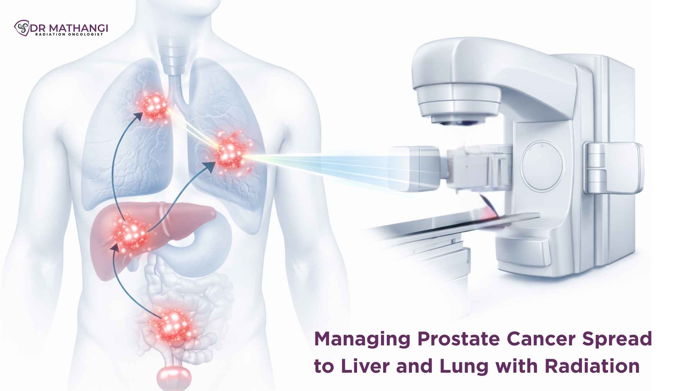 Prostate Cancer