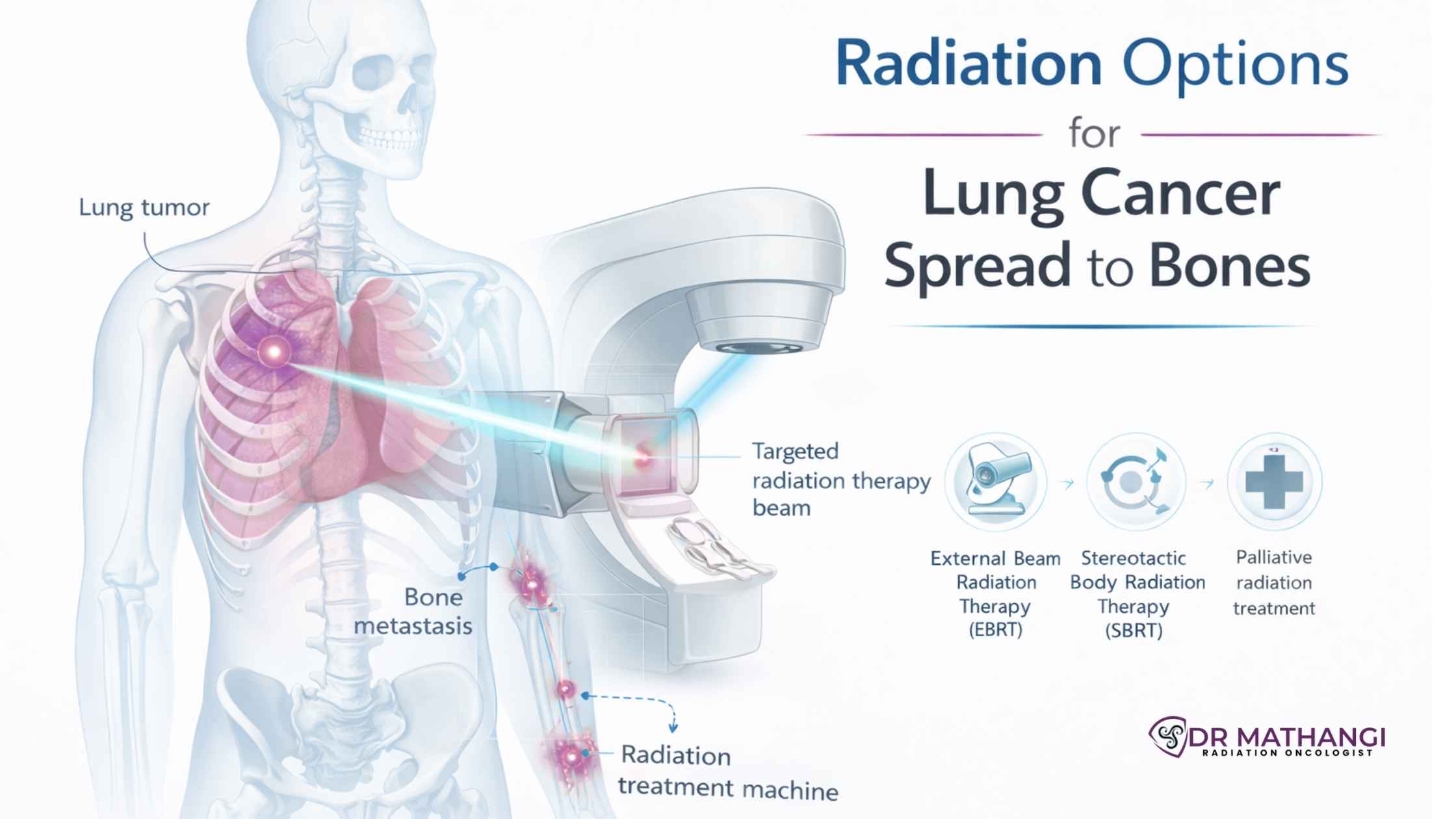 Lung Cancer Spread