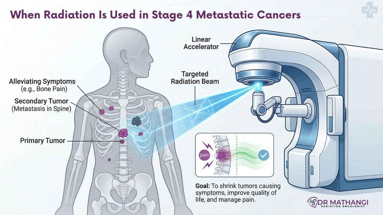 Radiation for Stage 4 Metastatic Cancer — Dr. Mathangi J