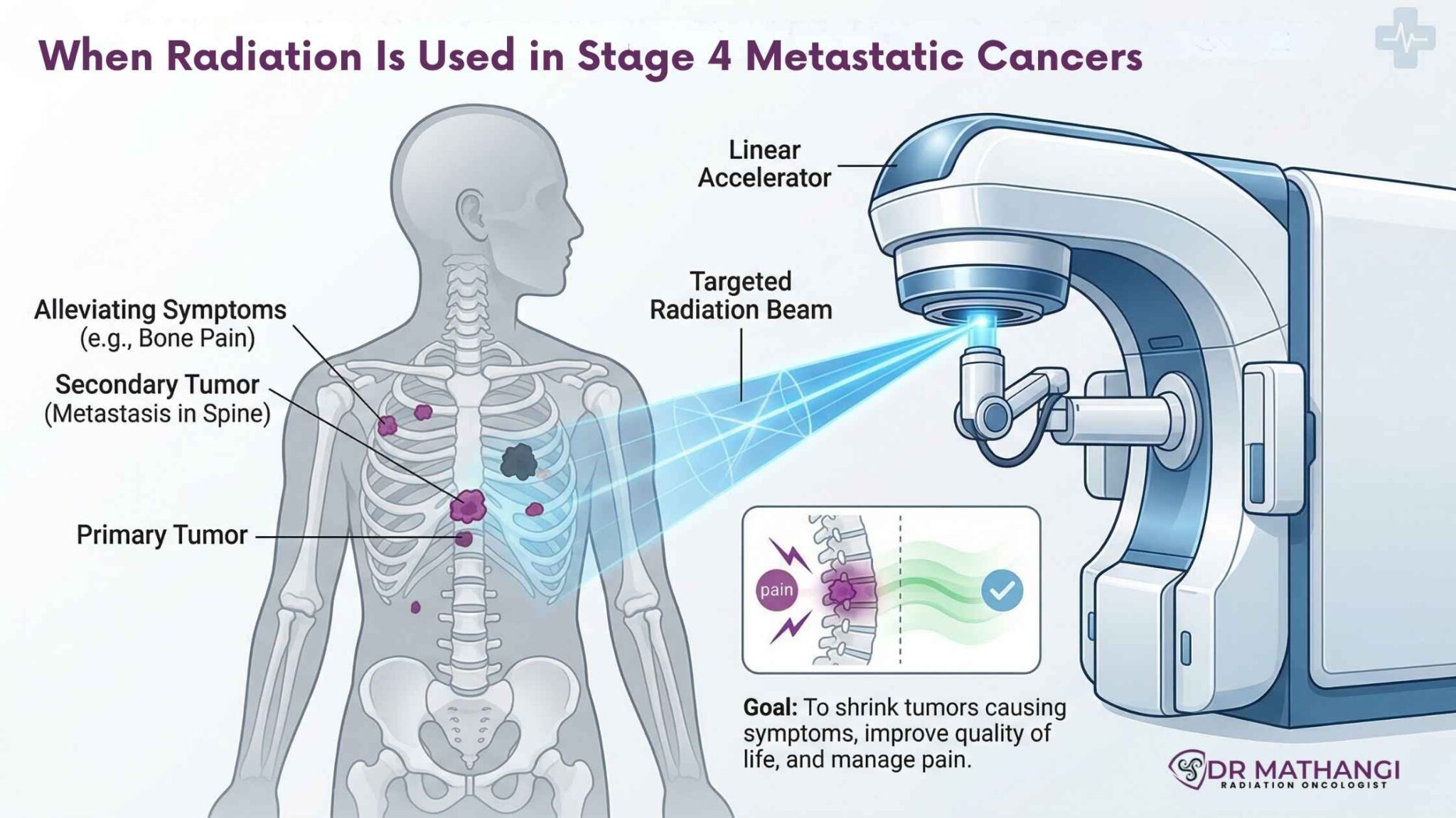 Radiation for Stage 4 Metastatic Cancer — Dr. Mathangi J