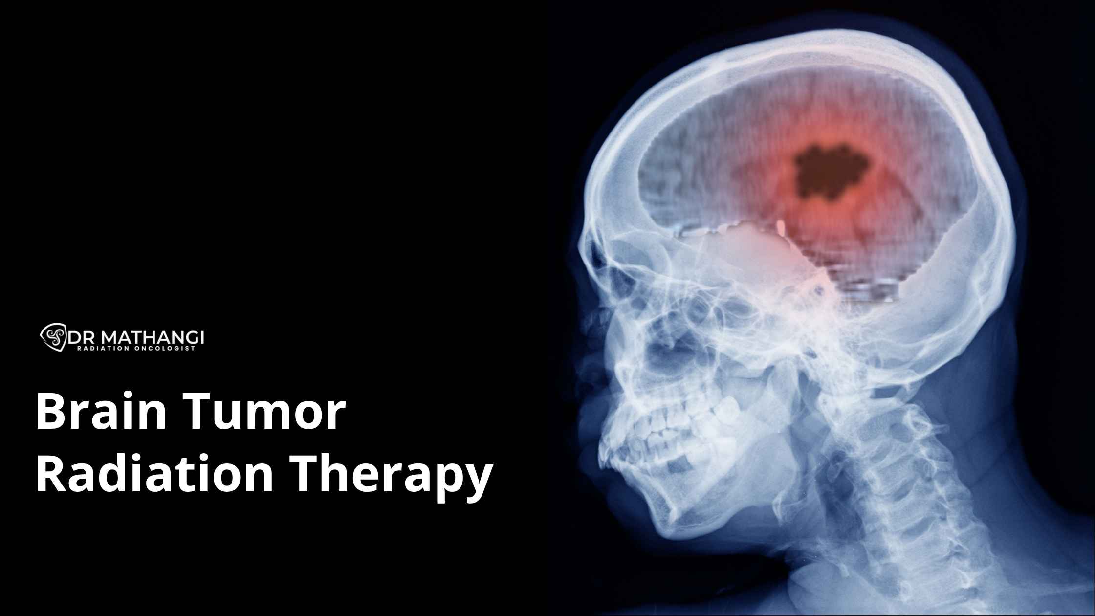 Brain Tumor