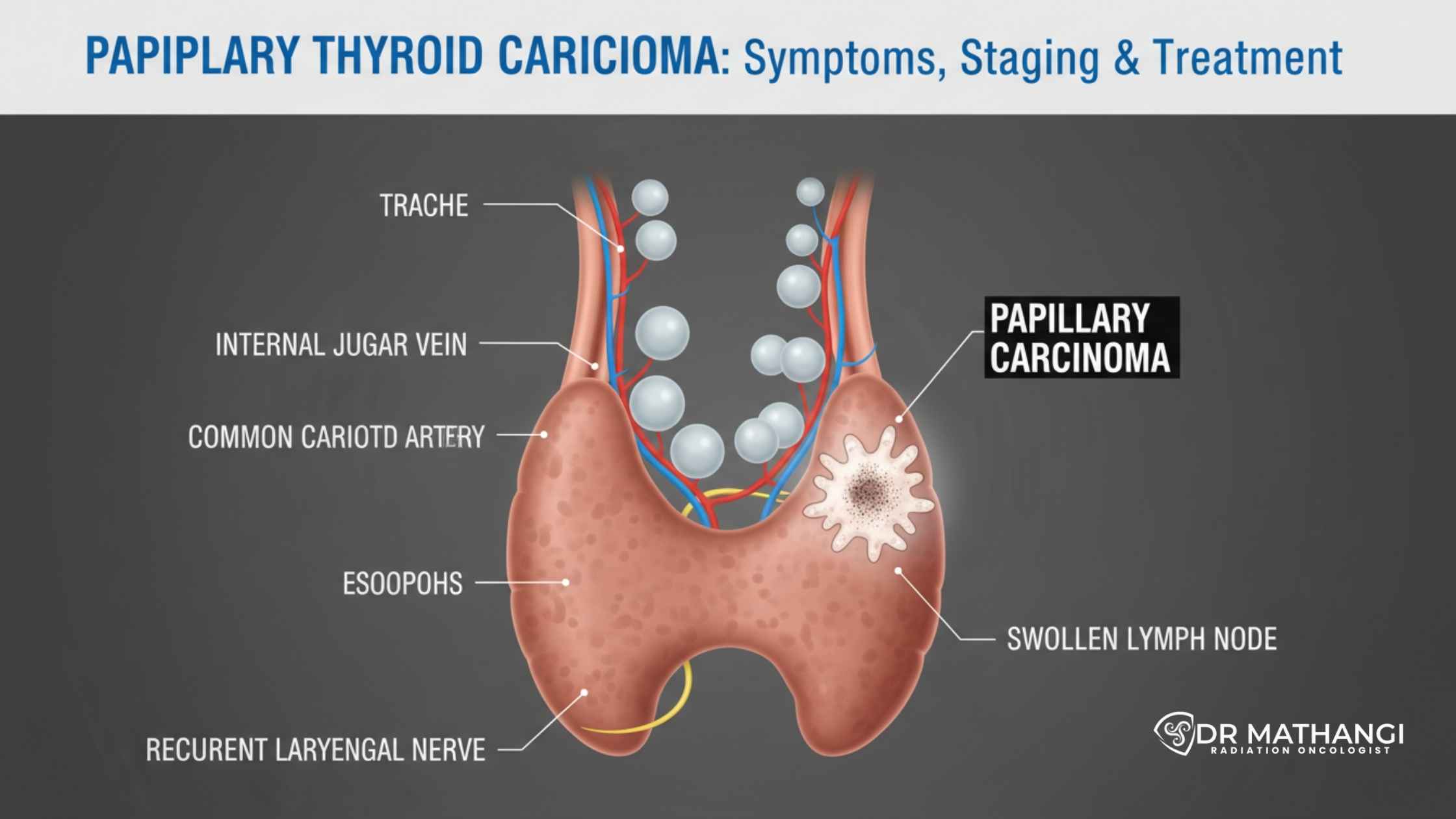 Papillary Thyroid Carcinoma: Symptoms, Staging & Treatment