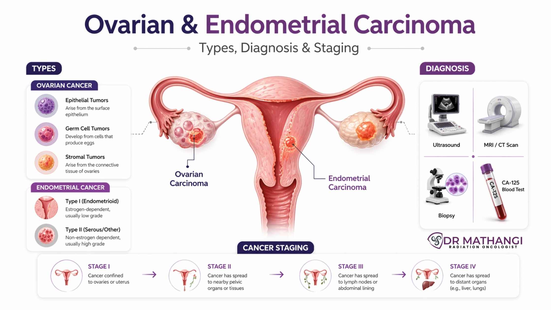 Ovarian & Endometrial Carcinoma: Types, Diagnosis & Staging