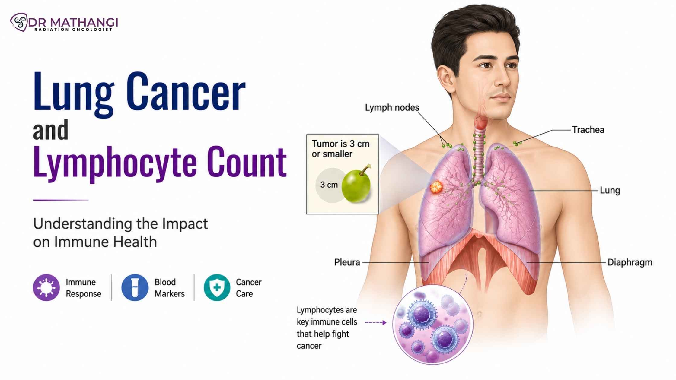 Lung Cancer and Lymphocyte Count