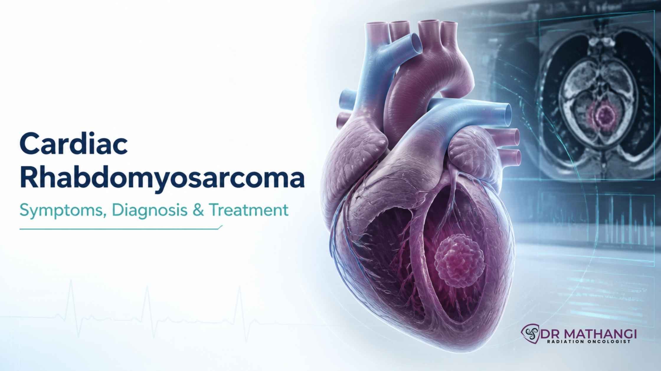 Cardiac Rhabdomyosarcoma: Symptoms, Diagnosis & Treatment