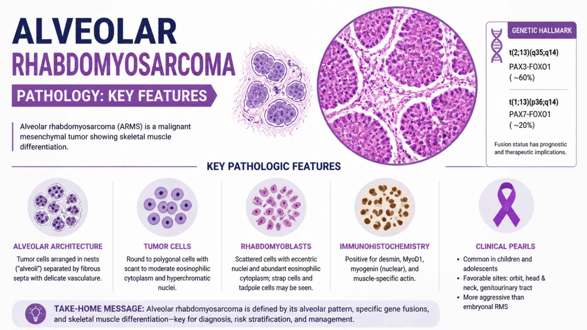 Alveolar Rhabdomyosarcoma Pathology: Key Features