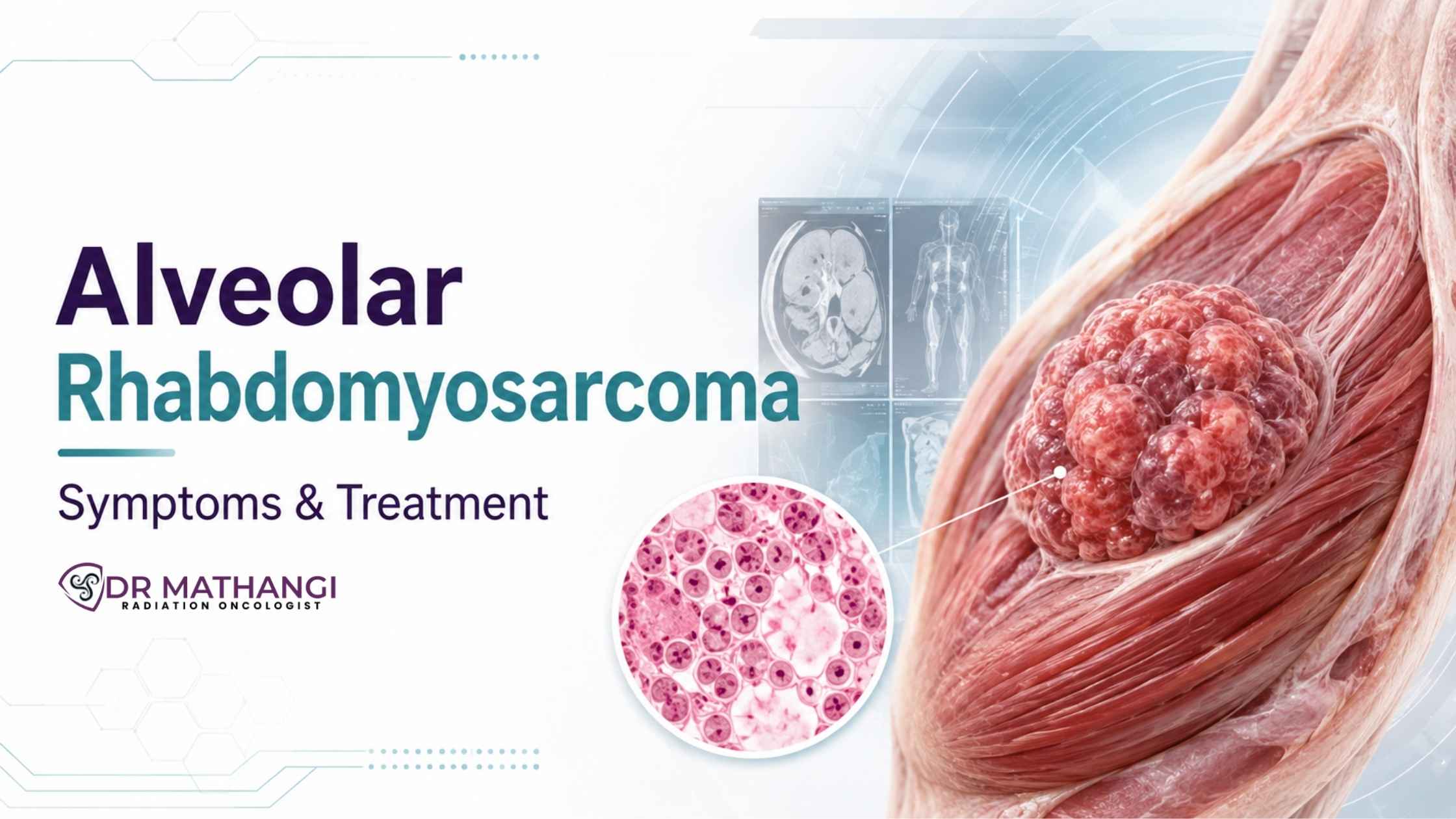 Alveolar Rhabdomyosarcoma: Symptoms & Treatment