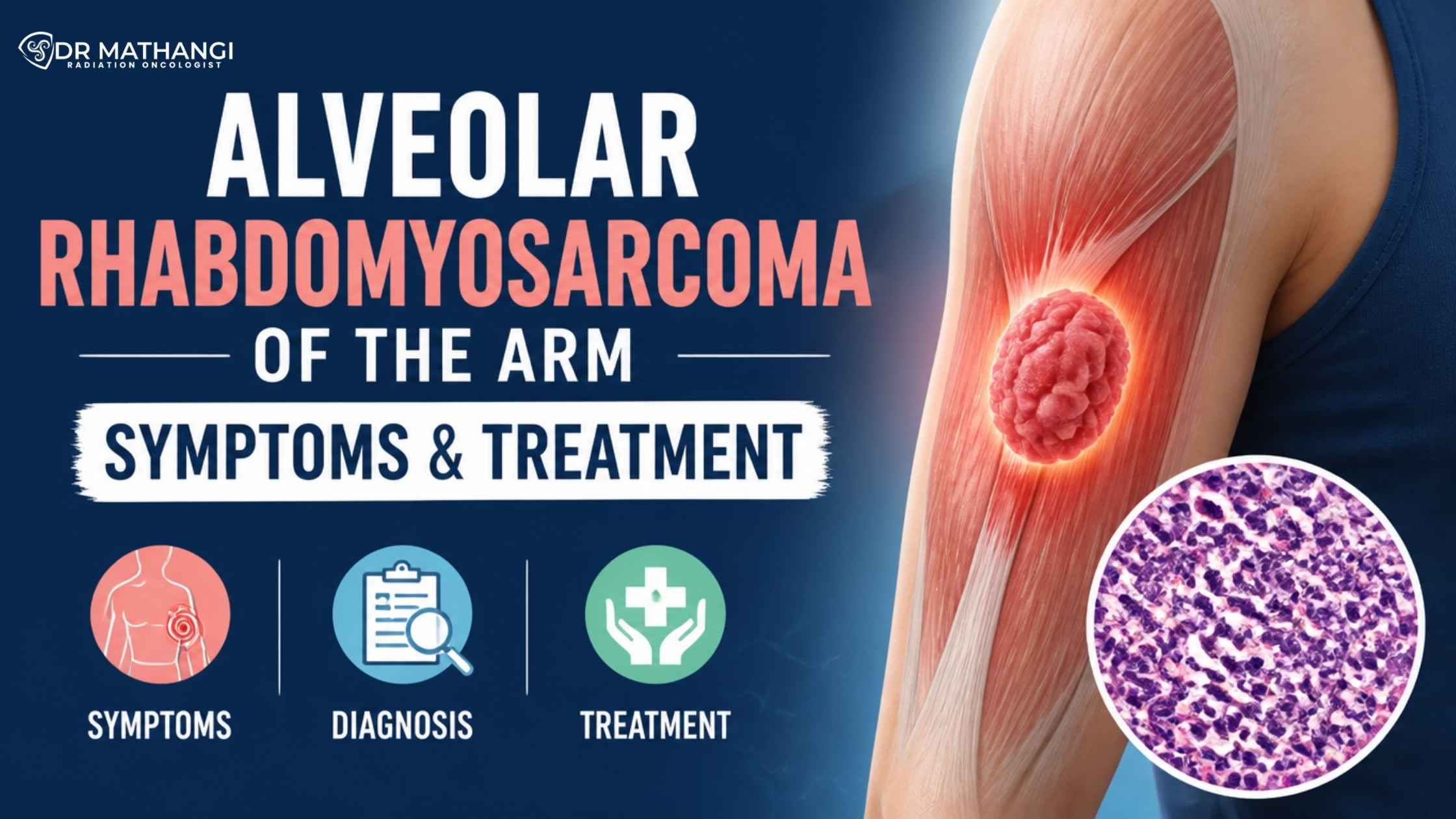 Alveolar Rhabdomyosarcoma of the Arm: Symptoms & Treatment