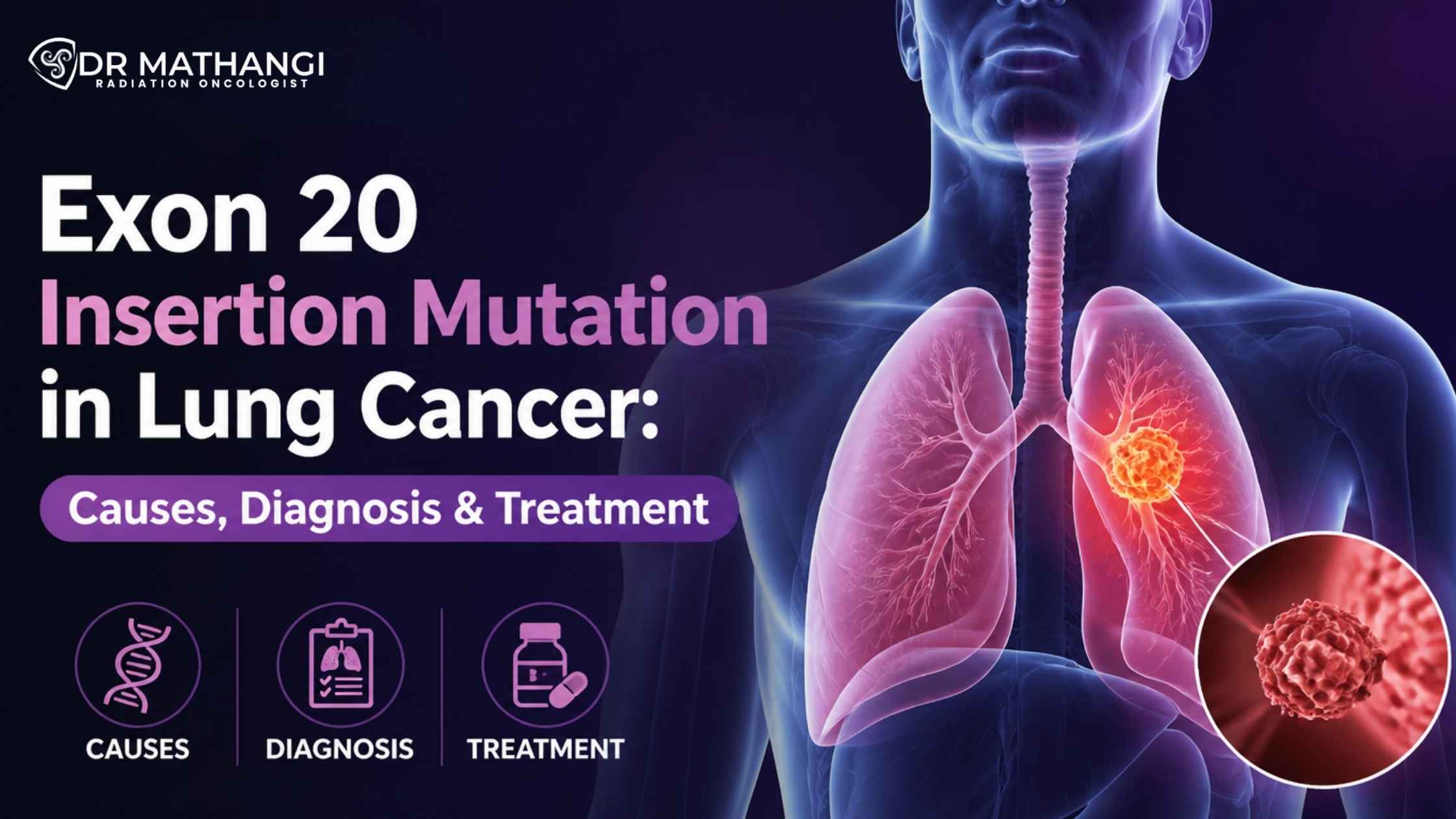 Exon 20 Insertion Mutation in Lung Cancer: Causes, Diagnosis & Treatment