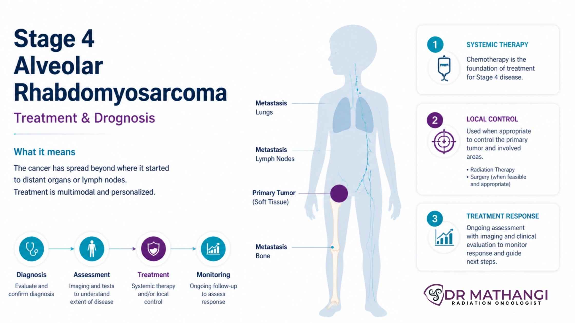 Stage 4 Alveolar Rhabdomyosarcoma: Treatment & Prognosis