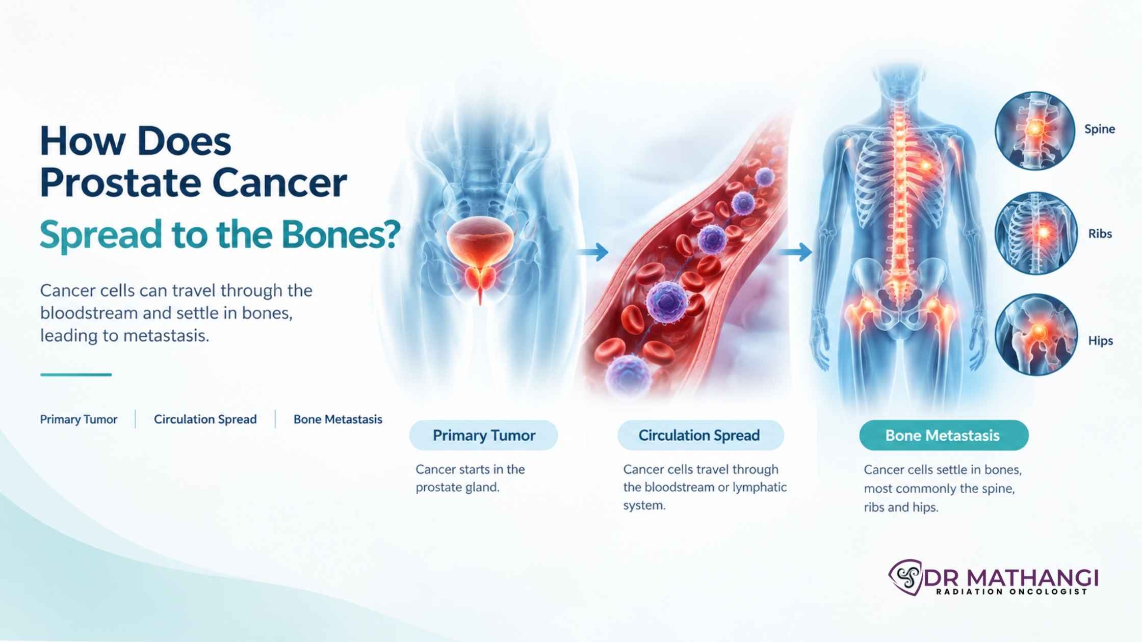 How Does Prostate Cancer Spread to the Bones?
