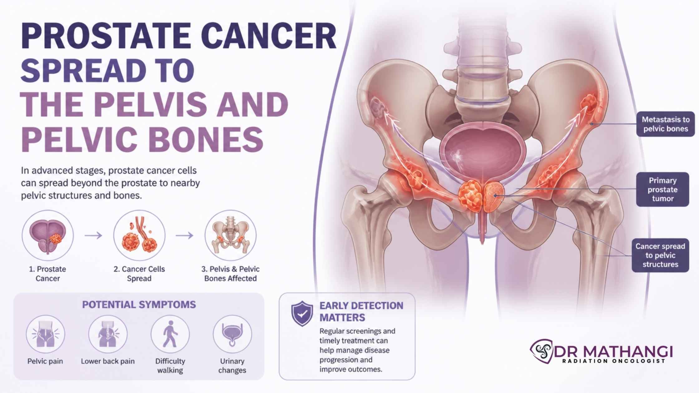 Prostate Cancer Spread to the Pelvis and Pelvic Bones