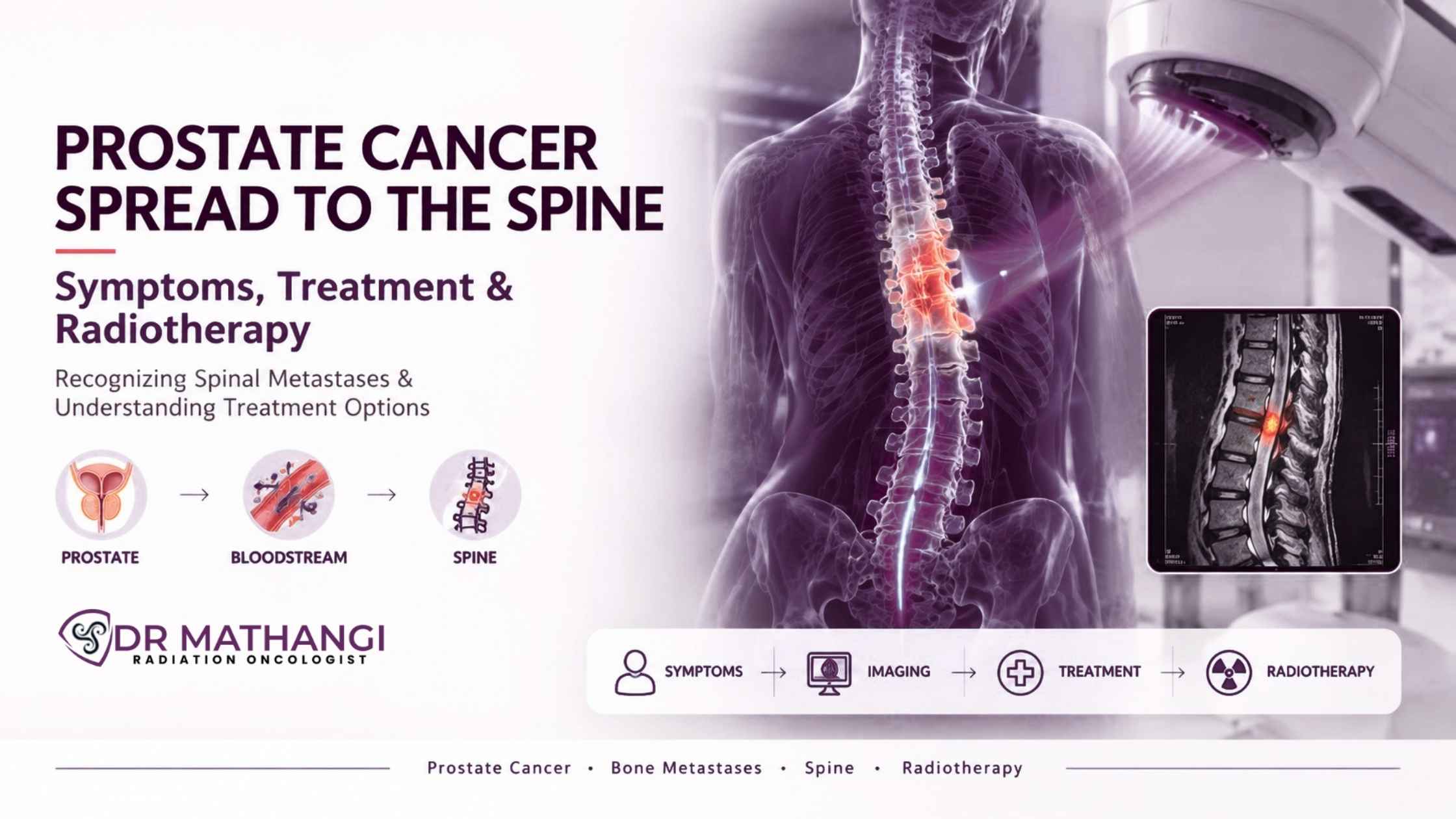 Prostate Cancer Spread to the Spine: Symptoms, Treatment & Radiotherapy
